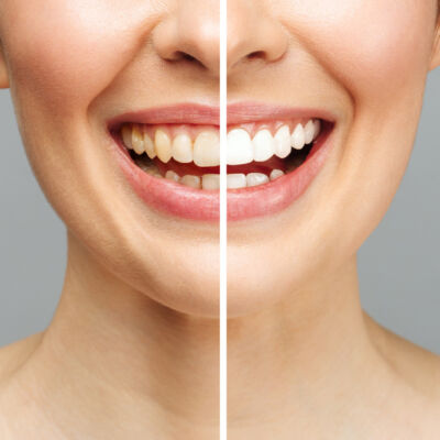 before-after-teeth-whitening-2